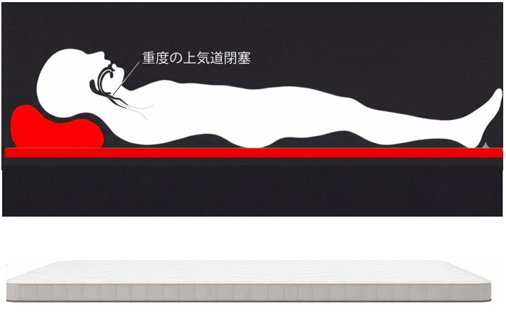 通常の寝具による圧迫と負荷