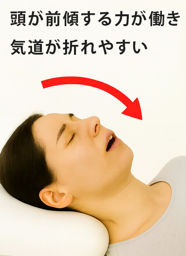 後頭部への体圧で頭が前傾し、気道が狭くなる様子