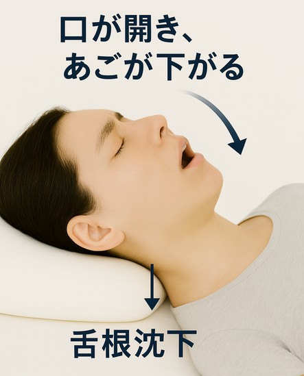 口が開き舌が下がることで舌根沈下が起こる様子